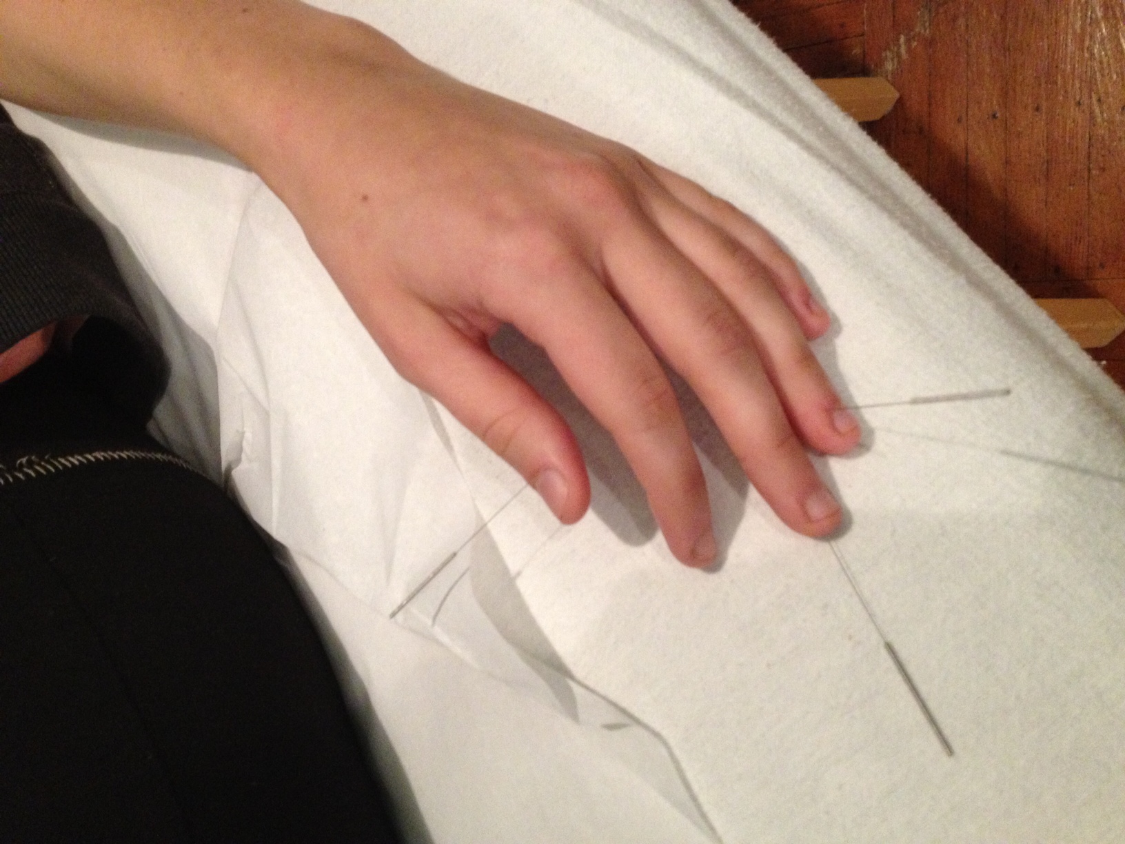 Hand acupuncture